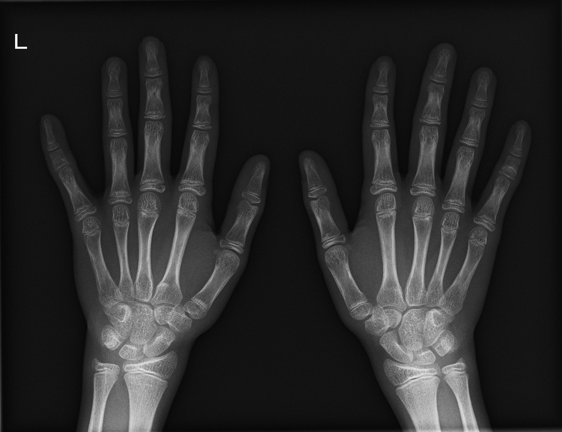 骨年齢評価の手根骨撮影