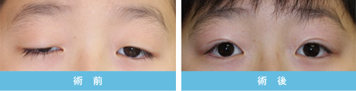 眼瞼下垂症 症状1