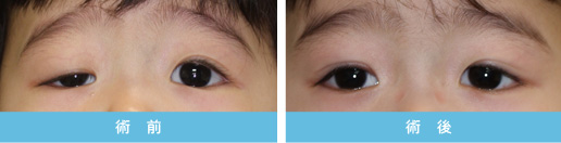 眼瞼下垂症 症状2