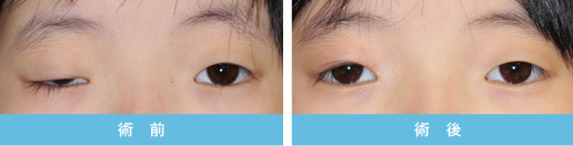 眼瞼下垂症 症状3