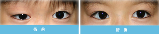 眼瞼下垂症 症状5