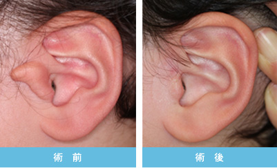 副耳 症状2