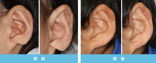 耳垂裂 症状1