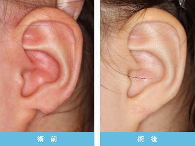 耳垂裂 症状2