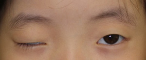 眼瞼下垂症