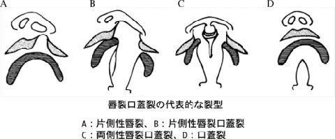 唇裂口蓋裂の代表的な裂型