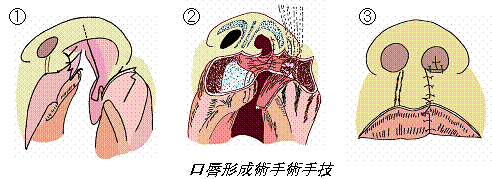 片側性の場合の手術の方法