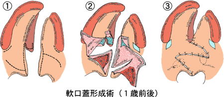 軟口蓋形成術（1歳前後）