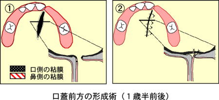 口蓋前方の形成術（1歳半前後）