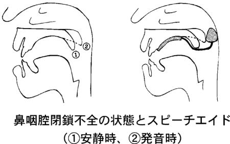 鼻咽腔閉鎖不全の状態とスピーチエイド