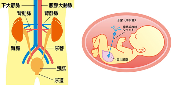 胎児泌尿器科疾患について