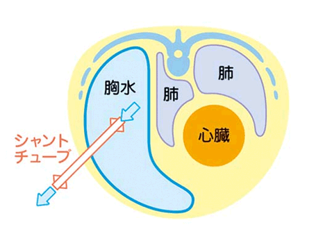 胎児胸水